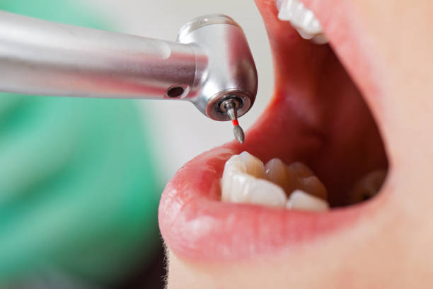 Best Emergency Wisdom Teeth Removal in Dawson, TX